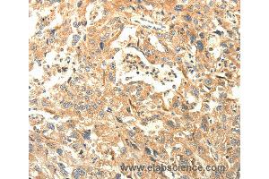 Immunohistochemistry of Human lung cancer using AGRN Polyclonal Antibody at dilution of 1:30 (AGRN antibody)