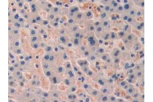 Detection of TERF1 in Human Liver cancer Tissue using Polyclonal Antibody to Telomeric Repeat Binding Factor 1 (TERF1) (TRF1 antibody  (AA 148-428))