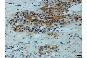 Immunohistochemistry of paraffin-embedded human cervical carcinoma using MMP1 antibody. (MMP1 antibody  (AA 20-280))