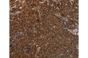 Immunohistochemistry of Human cervical cancer using KDM4B Polyclonal Antibody at dilution of 1:50