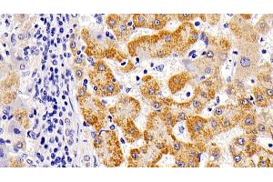 Detection of LAMP1 in Human liver cirrhosis Tissue using Polyclonal Antibody to Lysosomal Associated Membrane Protein 1 (LAMP1) (LAMP1 antibody  (AA 49-297))