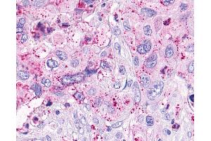 Anti-OXER1 antibody IHC of human Pancreas, Carcinoma. (OXER1 antibody  (C-Term))