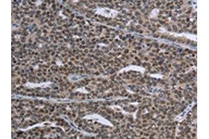 The image on the left is immunohistochemistry of paraffin-embedded Human ovarian cancer tissue using ABIN7191353(MAGEC1 Antibody) at dilution 1/30, on the right is treated with synthetic peptide. (MAGEC1 antibody)