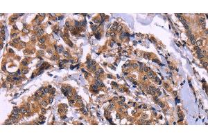 Immunohistochemistry of paraffin-embedded Human breast cancer using AMIGO2 Polyclonal Antibody at dilution of 1:50 (AMIGO2 antibody)