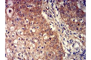 Immunohistochemical analysis of paraffin-embedded stomach cancer tissues using GRM3 mouse mAb with DAB staining. (Metabotropic Glutamate Receptor 3 antibody  (AA 433-576))