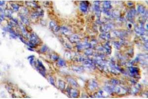 Immunohistochemistry (IHC) analyzes of COL1A2 antibody in paraffin-embedded human colon carcinoma tissue. (COL1A2 antibody  (Chain alpha 2))