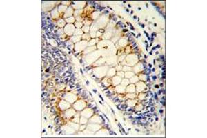 Formalin-Fixed, Paraffin-Embedded Human colon carcinoma reacted with SFRS1 Antibody (C-term), which was Peroxidase-conjugated to the secondary antibody, followed by DAB staining. (SRSF1 antibody  (C-Term))