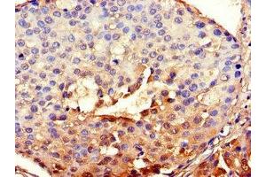 Immunohistochemistry of paraffin-embedded human breast cancer using ABIN7147837 at dilution of 1:100 (BHLHE40 antibody  (AA 184-302))