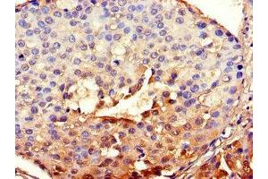 Immunohistochemistry of paraffin-embedded human breast cancer using ABIN7147837 at dilution of 1:100 (Aryl Hydrocarbon Receptor Nuclear Translocator Homolog (TGO) (AA 184-302) antibody)