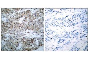 Immunohistochemical analysis of paraffin-embedded human breast carcinoma tissue using BAD (phospho-Ser112) antibody (E011067) . (BAD antibody  (pSer112))