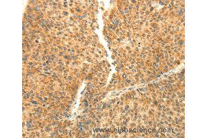 Immunohistochemistry of Human liver cancer using AARS2 Polyclonal Antibody at dilution of 1:80 (AARS2 antibody)