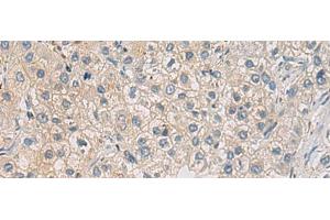 Immunohistochemistry of paraffin-embedded Human liver cancer tissue using WFDC3 Polyclonal Antibody at dilution of 1:40(x200) (WFDC3 antibody)