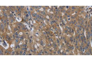 Immunohistochemistry of paraffin-embedded Human ovarian cancer using SOCS1 Polyclonal Antibody at dilution of 1:90 (SOCS1 antibody)