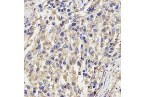 Immunohistochemistry of paraffin-embedded human lung cancer using KLRD1 antibody at dilution of 1:200 (x400 lens) (CD94 antibody)