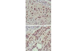 Immunohistochemical analysis of paraffin-embedded human lung cancer (upper) and cervical carcinoma (bottom) , showing nuclear localization using ISL1 monoclonal antibody, clone 1H9  with DAB staining.