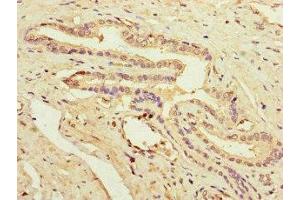 Immunohistochemistry of paraffin-embedded human prostate cancer using ABIN7162936 at dilution of 1:100 (Peroxiredoxin 2 antibody  (AA 2-65))