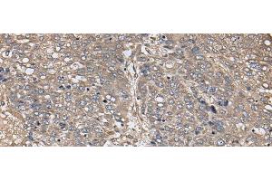 Immunohistochemistry of paraffin-embedded Human liver cancer tissue using ZFP36 Polyclonal Antibody at dilution of 1:40(x200) (ZFP36 antibody)
