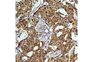 Immunohistochemical analysis of HSC70 staining in human breast cancer formalin fixed paraffin embedded tissue section. (Hsc70 antibody)