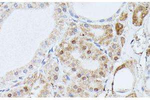 Immunohistochemistry of paraffin-embedded Human thyroid cancer using PPP2R5D Polyclonal Antibody at dilution of 1:100 (40x lens).