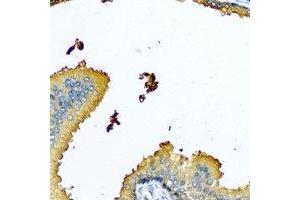 Immunohistochemical analysis of Nyctalopin staining in human prostate formalin fixed paraffin embedded tissue section. (Nyctalopin antibody)