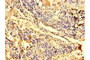 Immunohistochemistry of paraffin-embedded human lung cancer using ABIN7176377 at dilution of 1:100 (ZNF559 antibody  (AA 1-300))