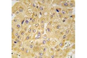 IHC analysis of FFPE human hepatocarcinoma tissue stained with Integrin linked kinase antibody (ILK antibody  (AA 11-41))