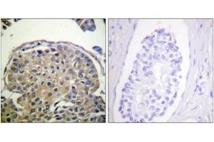 Immunohistochemistry analysis of paraffin-embedded human breast carcinoma, using CD227/Mucin 1 (Phospho-Tyr1243) Antibody. (MUC1 antibody  (pTyr1243))