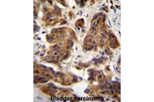 C4orf21 Antibody (N-term) immunohistochemistry analysis in formalin fixed and paraffin embedded human bladder carcinoma followed by peroxidase conjugation of the secondary antibody and DAB staining. (ZGRF1 antibody  (N-Term))