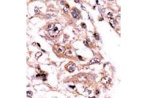 Formalin-fixed and paraffin-embedded human cancer tissue reacted with the primary antibody, which was peroxidase-conjugated to the secondary antibody, followed by AEC staining. (PPP3CC antibody  (C-Term))