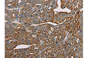 The image on the left is immunohistochemistry of paraffin-embedded Human cervical cancer tissue using ABIN7130290(MTFP1 Antibody) at dilution 1/30, on the right is treated with fusion protein. (Mtfp1 antibody)