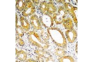 Immunohistochemical analysis of PDK4 staining in human colon cancer formalin fixed paraffin embedded tissue section. (PDK4 antibody)