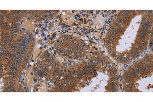 Immunohistochemistry of paraffin-embedded Human colon cancer tissue using NPTX1 Polyclonal Antibody at dilution 1:50 (NPX1 antibody)