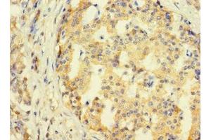 Immunohistochemistry of paraffin-embedded human pancreatic cancer using ABIN7171165 at dilution of 1:100 (SYTL3 antibody  (AA 1-300))
