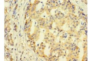 Immunohistochemistry of paraffin-embedded human pancreatic cancer using ABIN7171165 at dilution of 1:100