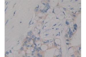 Detection of IGF1 in Human Bile duct cancer Tissue using Polyclonal Antibody to Insulin Like Growth Factor 1 (IGF1) (IGF1 antibody  (AA 49-118))