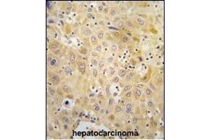 Formalin-fixed and paraffin-embedded human hepatocarcinoma tissue reacted with Autophagy G7L Antibody (N-term) 1813a , which was peroxidase-conjugated to the secondary antibody, followed by DAB staining. (ATG7 antibody  (N-Term))