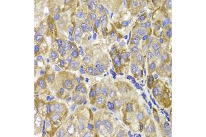 Immunohistochemistry of paraffin-embedded human liver cancer using MAGED1 antibody. (MAGED1 antibody)