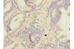 Immunohistochemistry of paraffin-embedded human prostate cancer using ABIN7160892 at dilution of 1:100 (NDUFA13 antibody  (AA 52-144))