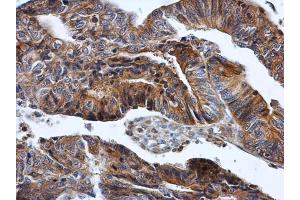 IHC-P Image HPRT antibody detects HPRT protein at cytoplasm in human colon cancer by immunohistochemical analysis.