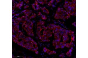 Immunofluorescence of paraffin embedded human breast cancer using Epl4 (ABIN7073843) at dilution of 1:2000 (300x lens) (EFNA4 antibody)
