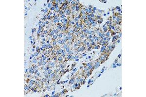 Immunohistochemistry of paraffin-embedded human lung cancer using MRPL28 antibody. (MRPL28 antibody  (AA 1-256))