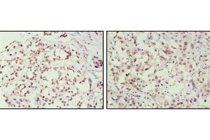 Immunohistochemical analysis of paraffin-embedded human breast cancer (left) and lung cancer (right) tissues, showing nuclear localization using MSH2 mouse mAb with DAB staining. (MSH2 antibody)