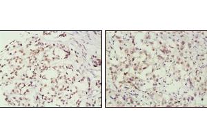 Immunohistochemical analysis of paraffin-embedded human breast cancer (left) and lung cancer (right) tissues, showing nuclear localization using MSH2 mouse mAb with DAB staining.