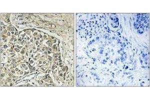 Immunohistochemistry analysis of paraffin-embedded human lung carcinoma tissue, using ARSD Antibody. (Arylsulfatase D antibody  (AA 331-380))