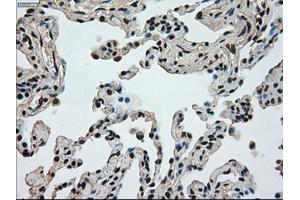 Immunohistochemical staining of paraffin-embedded Adenocarcinoma of breast tissue using anti-MKI67 mouse monoclonal antibody.