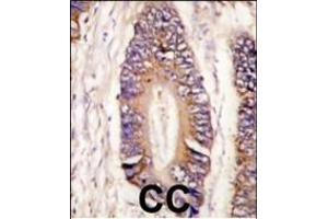 Formalin-fixed and paraffin-embedded human colon carcinoma tissue reacted with MLK4 antibody (N-term) (ABIN392542 and ABIN2842092) , which was peroxidase-conjugated to the secondary antibody, followed by DAB staining. (MLK4 antibody  (N-Term))