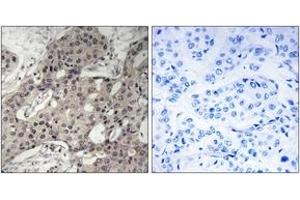Immunohistochemistry analysis of paraffin-embedded human breast carcinoma tissue, using RPL3 Antibody. (RPL3 antibody  (AA 211-260))