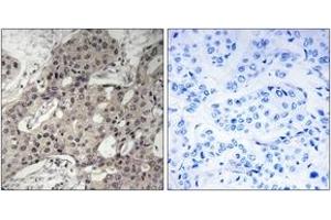 Immunohistochemistry analysis of paraffin-embedded human breast carcinoma tissue, using RPL3 Antibody. (RPL3 antibody  (AA 211-260))