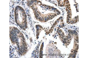 Immunohistochemistry of Human colon cancer using KLK7 Polyclonal Antibody at dilution of 1:10