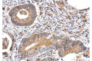 IHC-P Image OFD1 antibody detects OFD1 protein at cytosol on human gastric cancer by immunohistochemical analysis.